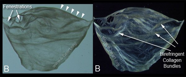 Pulmonic Valve Polarized